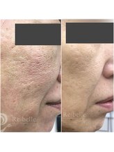 ワイエス サロン 東陽町(Ys Salon)/頑固な毛穴やお肌の凹凸にも