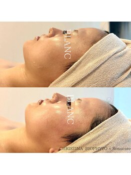 サロン ド ブラン アオヤマ(Salon de BLANC AOYAMA)/毛穴悩みの解消!つるぴか肌へ