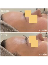 シースキン 盛岡駅前店(c.skin)/お客様ビフォーアフター♪