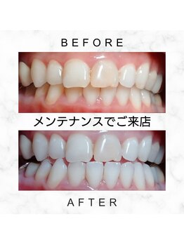 エミリアホワイトニング(EMIRIA WHITENING)/Before/After
