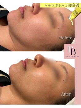 フォトビズ/二重顎、解消！レモンボトル