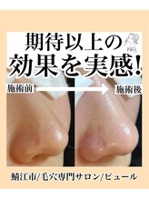 ピュール 鯖江店(PUR)/毛穴/毛穴ケア/毛穴洗浄