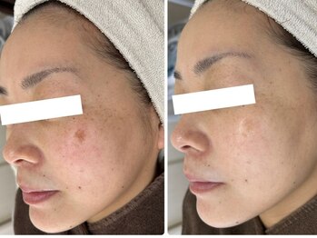 アンド ユー(and.yu)の写真/肌の奥から輝きを取り戻す!その場だけではない、この先も美しく保てる肌質改善を致します☆