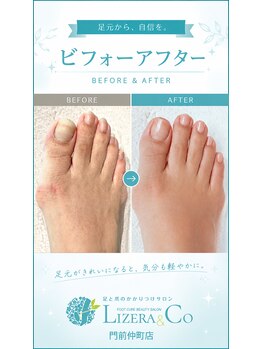 リゼラアンドコー 門前仲町店/気になる２枚爪・くすんだ爪