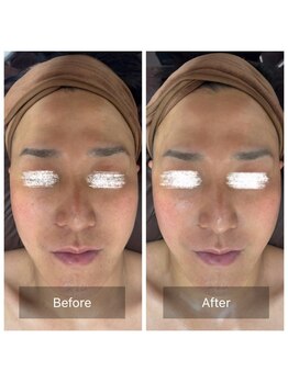 ラビ(RABBI)/30代男性　毛穴洗浄