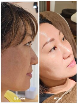 アン 銀座(ann)/エクソソーム&レモンボトル