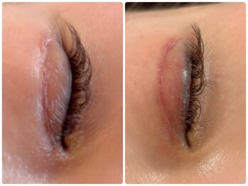 ルーシーガーデン(LUCY GARDEN)/ダウンタイム顔や目や鼻や顎など