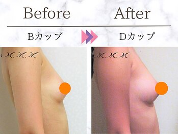 メディカルサロン エム エム エム 銀座プレミアムサロン(M.M.M.)/【バストアップ例】 B→Dカップ
