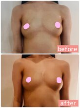 アイン 銀座(Ain)/バストアップ例　３