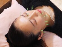 藤本整骨院 鍼灸院 長崎岩屋町本院/美容鍼メニュー♪