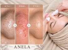 アネラ(ANELA)