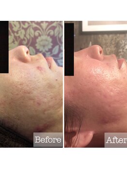 パウザ(PAUSA)/繰り返すニキビケアやマスク荒れ