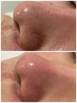 シェルビー(Cielbe.)/毛穴エクストラクションtete式