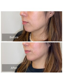 カドル 福岡天神店(KADORU)/小顔矯正+美容機器 Before-Aftet