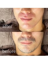 ムート(Mut.)/男性ヒゲワックス＋光脱毛。