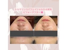 サロンド ユニバース(salon de universe)/トルマリンスパフェイシャル