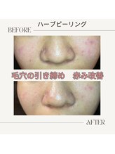 アノネ(Anone.)/ハーブピーリングBefore After