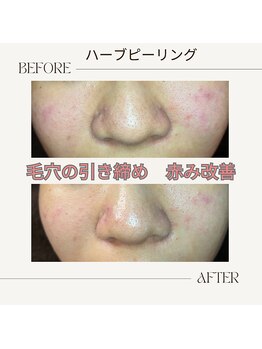 アノネ(Anone.)/ハーブピーリングBefore After