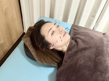ロハリ(Lohari)の写真/話題の美容鍼が体験できる◎顔のリフトアップはもちろん!むくみ・たるみ改善・肌トラブル・ニキビケア!