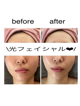 アルーア(Allure)/光フェイシャルbefore after