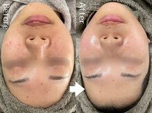 サロンエメ(salon aimer)の雰囲気（赤み、敏感肌、オイリー肌色んな肌質の方に受けていただけます☆）