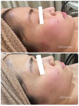 エステティック レイビス 青森店(RAYVIS)/全ての肌悩み、これで解決！