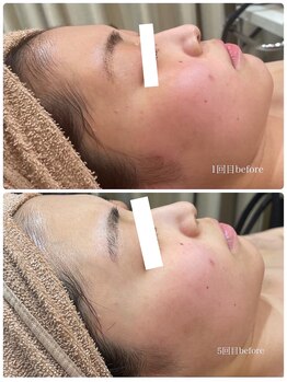 エステティック レイビス 青森店(RAYVIS)/全ての肌悩み、これで解決!