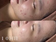 ホワイトアクア 鹿児島店(WHITE AQUA)/ハーブピーリング/鹿児島/荒田