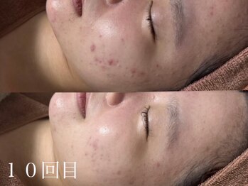 ホワイトアクア 鹿児島店(WHITE AQUA)/ハーブピーリング/鹿児島/荒田