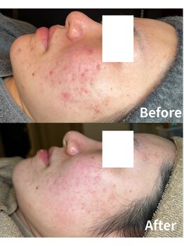 ミソル(misolle.)/ニキビケア 症例