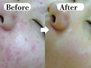 ビースキン 広島(BE:SKIN)/ミネラルピーリング/ニキビケア