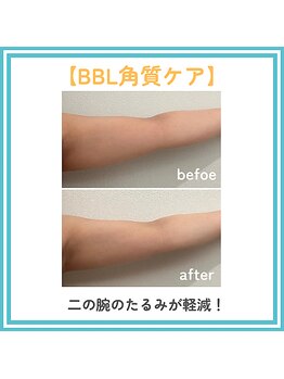 トッコ 那須塩原店(tocco)/BBL角質ケア