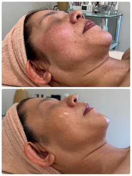ルミナス(luminous)の写真/キメ、ハリ感、毛穴の開き、ザラつき、くすみ改善が一気に叶う驚きの仕上がり♪夏の行事も美肌で気分アップ