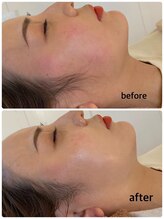 マーキュリー(Mercury)/ハーブピーリングのお客様