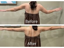 アトリエール(Ateliere)/二の腕術後ケア