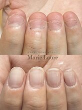 マリーロール 天王寺店(Marie Laure)/自爪育成/深爪矯正/ネイルケア