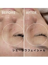 フェイエール鍼灸院 ラスィーヌ(fier鍼灸院 racine)/シミ・シワフェイシャル