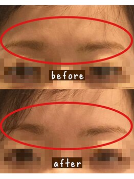 シンシンラボ 豪徳寺(SHINSHIN Lab)/美顔鍼で目元ケア