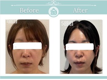 美人バスト 岡山店/【小顔コルギ症例】★