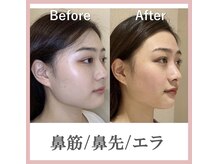 ラプリシュシュ 岡山店(Raplit)/ 隆鼻＋輪郭矯正40分10回