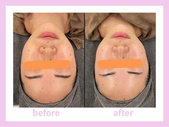 キワミビューティ(KIWAMI BEAUTY)/リブセラ/ビフォーアフター