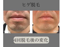 グロワール(gloire)/ヒゲ脱毛BeforeAfter