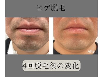 グロワール(gloire)/ヒゲ脱毛BeforeAfter