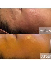 パウザ(PAUSA)/ハーブピーリング当店実績