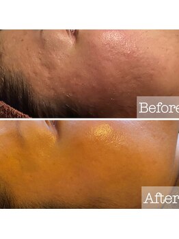 パウザ(PAUSA)/ハーブピーリング当店実績