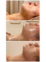 アラマンダ(Allamanda)/あご下BeforeAfter