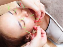 華藤 池袋店(KADOU)/スペシャルコース☆美容鍼＋鍼灸