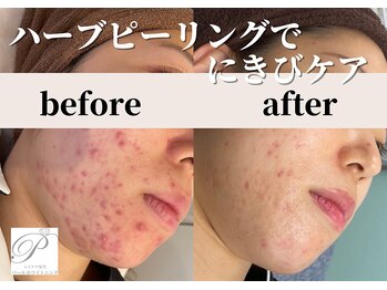 パールホワイトニングサロン 小田原店/ニキビケア/シミケア