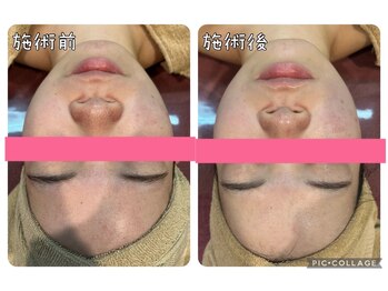 エステティック レイビス 銀座店(RAYVIS)/ホワイトスノーピール