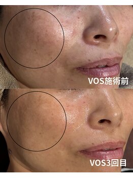 カルナ(CARNA)/シミ・毛穴レス肌